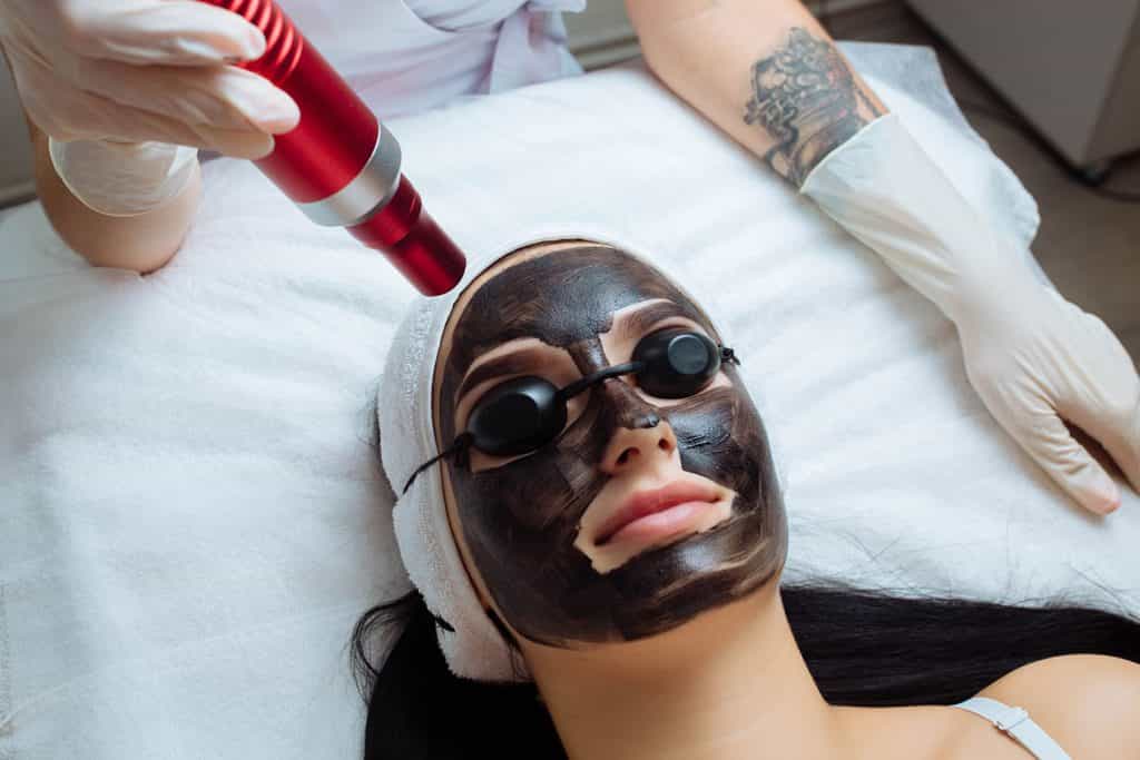Carbon Laser Peel