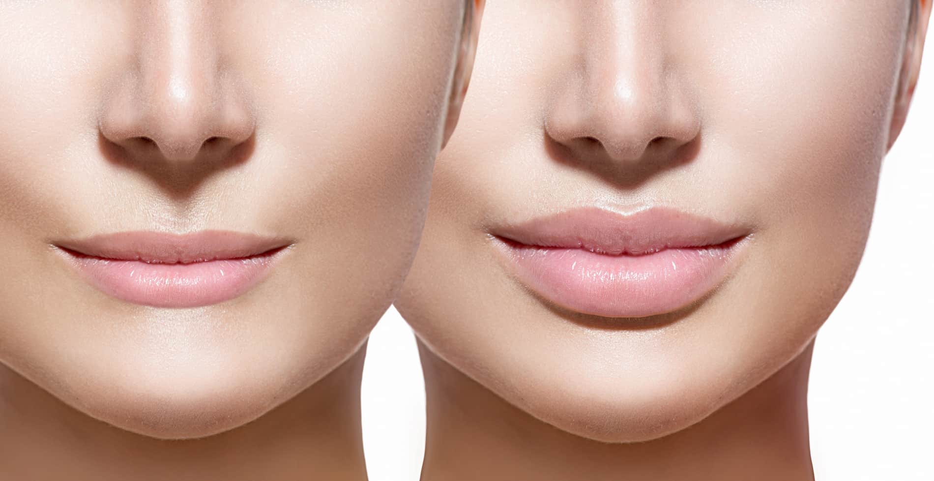 Lip Filler